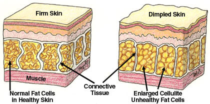 cellulite-causes