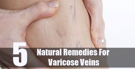 natural varicose vein remedy