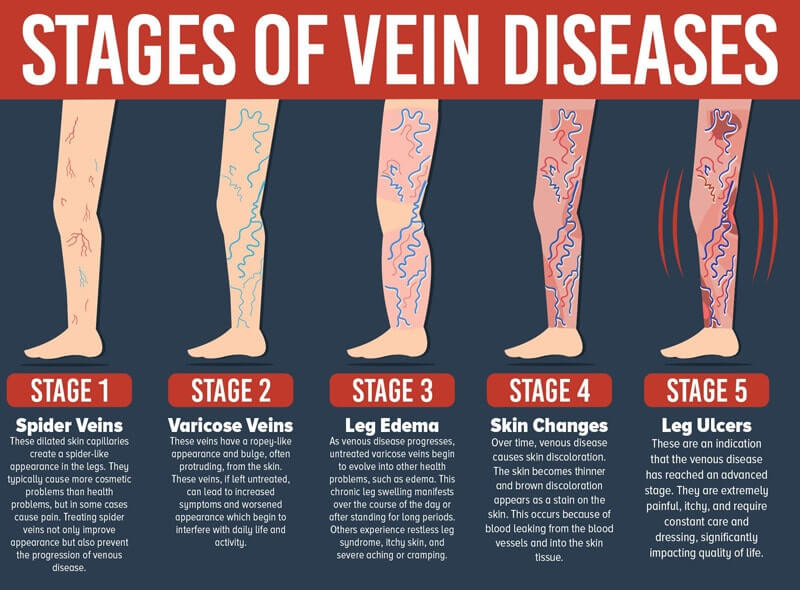 stages of varicose veins